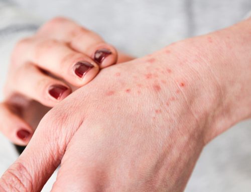 Antihistamines likely offer no meaningful benefit for eczema and may increase harms