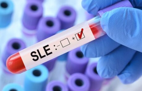 SLE blood test vial